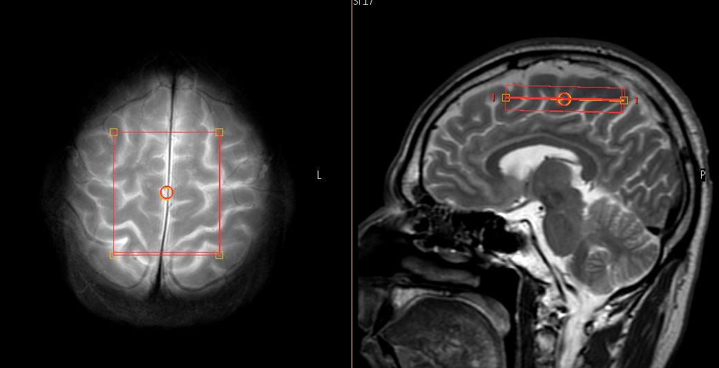 Brain damage from carbon monoxide shown on MRI