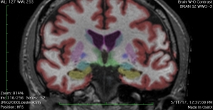 MRI for carbon monoxide diagnosis