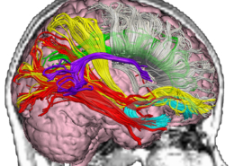 mild traumatic brain injury rehab